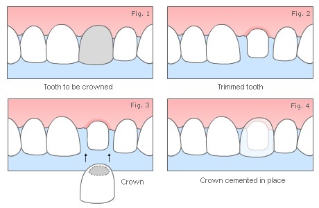 What is the dental procedure code for porcelain crowns and veneers?