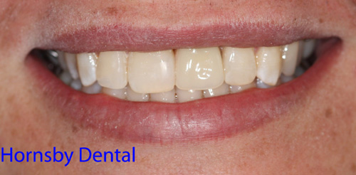 hornsby-dentist-4-after