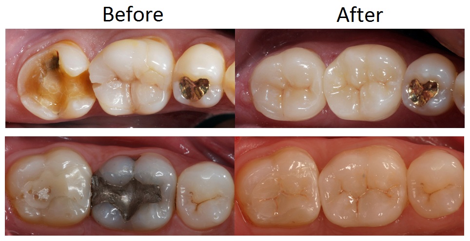 Dental Crown Pictures
