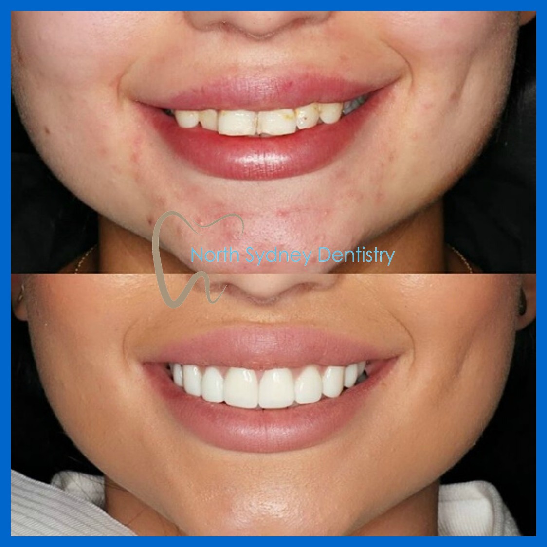 Porcelain veneers in North Sydney