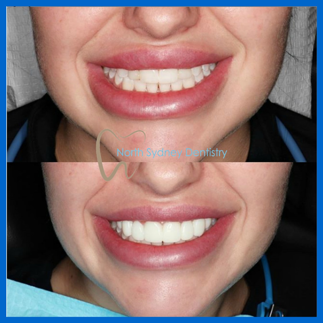 Best dentist for veneers in North Sydney