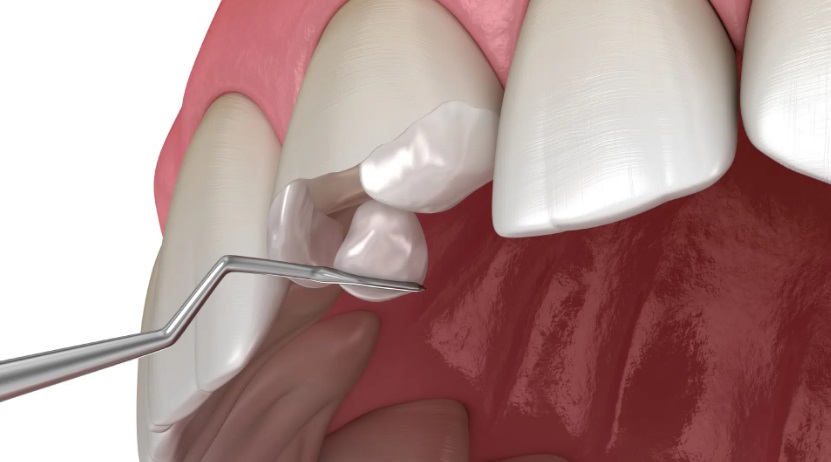 Composite Resin Veneers