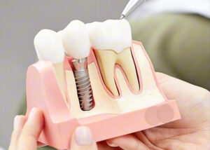 How much are dental implants?