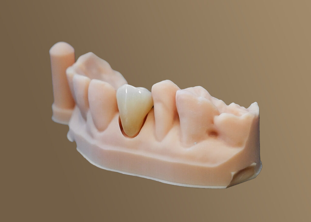 Price for Dental Crowns