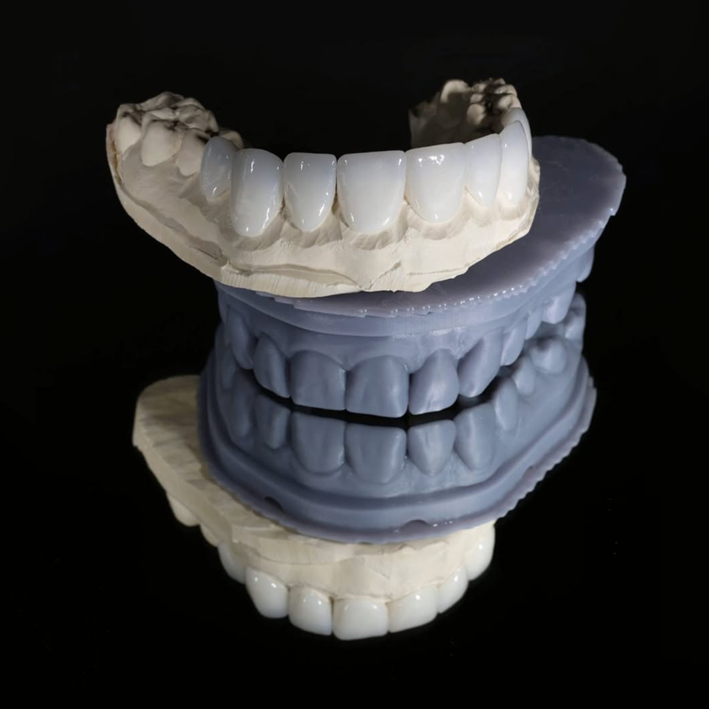 cost of Porcelain Veneers