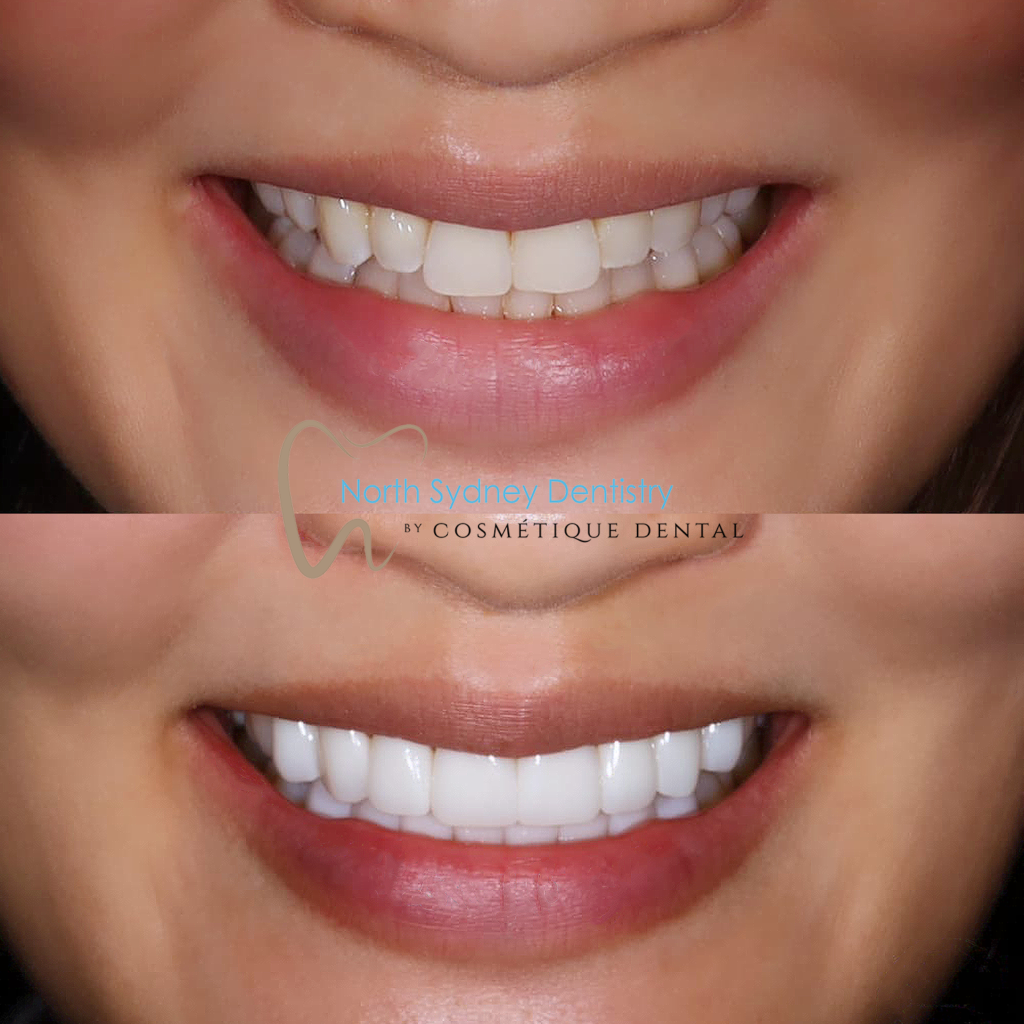 Dental Veneers Before and After