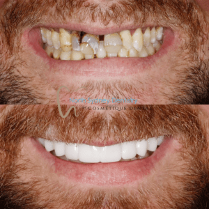 dental-implant