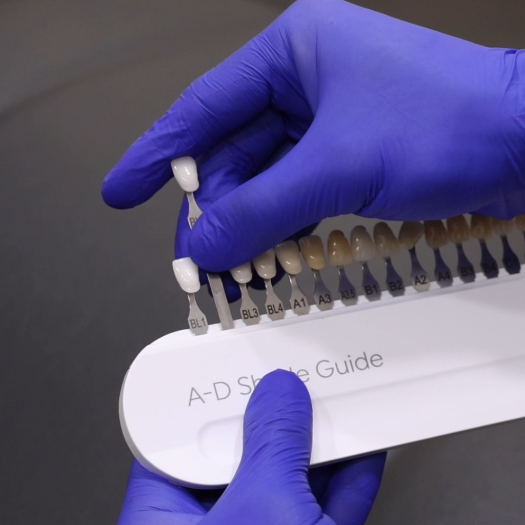 Composite Veneers in North Sydney