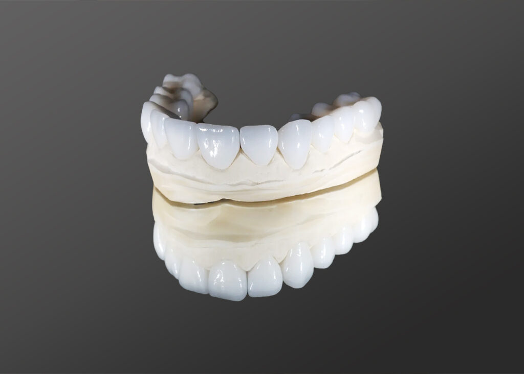 A dental model showing thin porcelain veneers placed over the front surface of human teeth to improve their appearance.