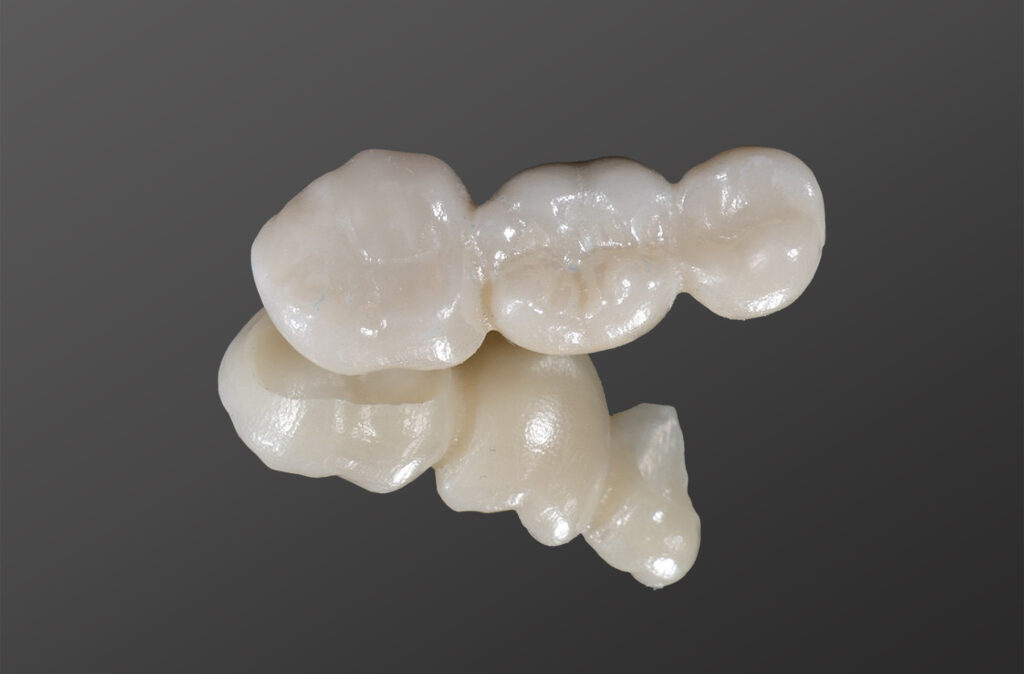 Dental Bridge