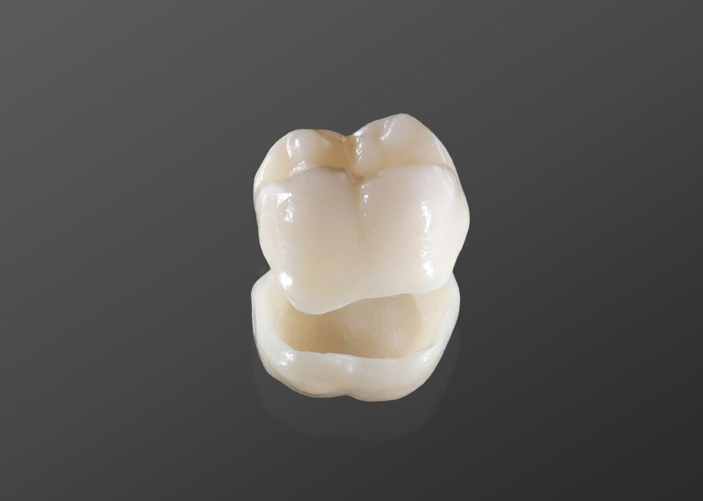 Dental crown fitted at North Sydney Dentistry