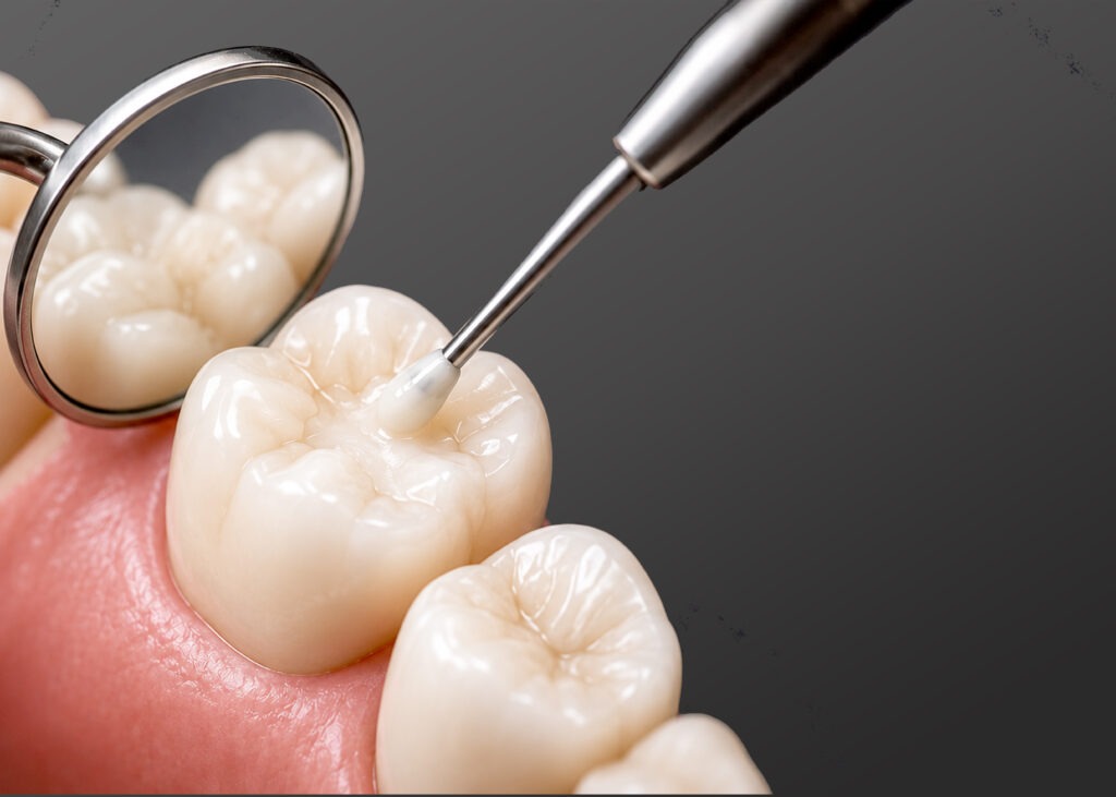Tooth-coloured dental filling in North Sydney