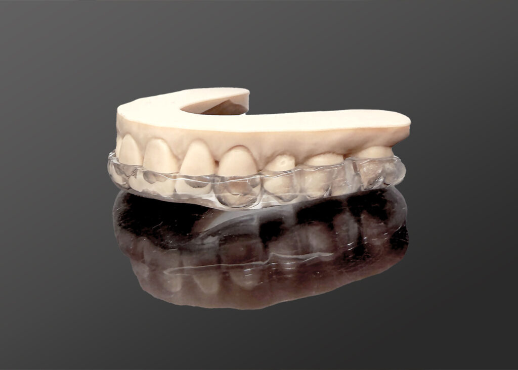 An educational model showing the discrete and virtually invisible look of clear aligners on teeth.