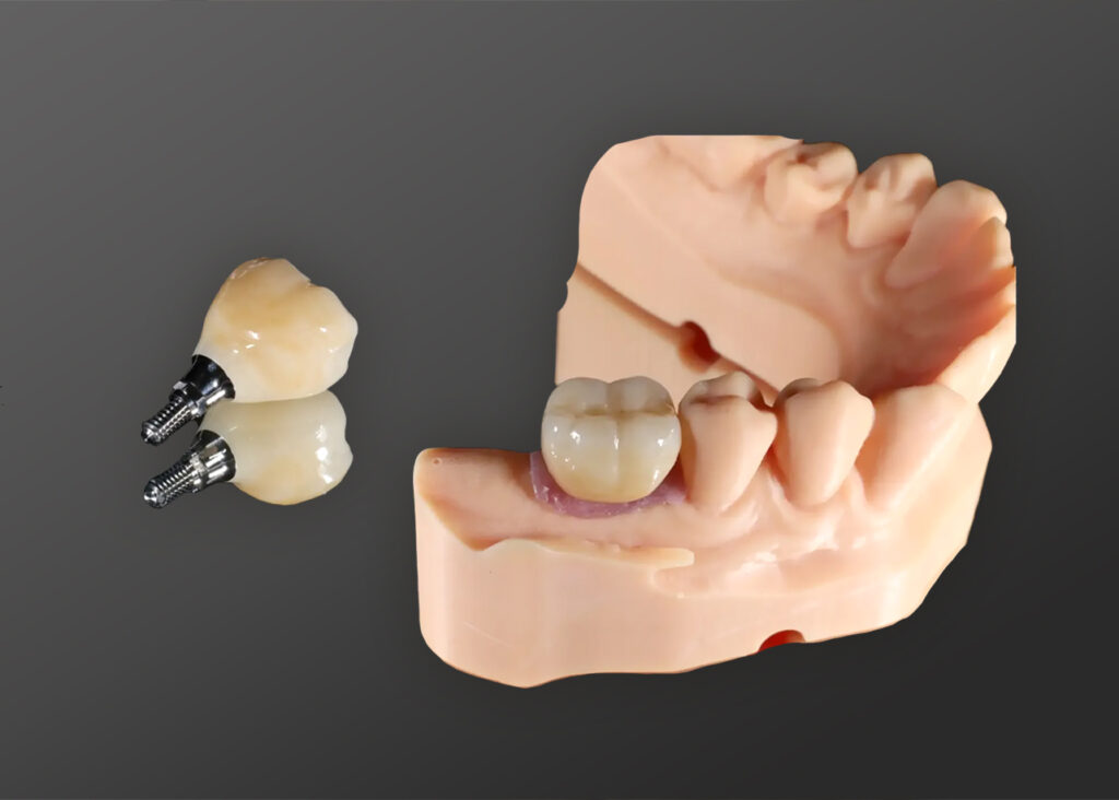 A cross-section dental model showing a tooth implant, including the artificial root, abutment, and crown.