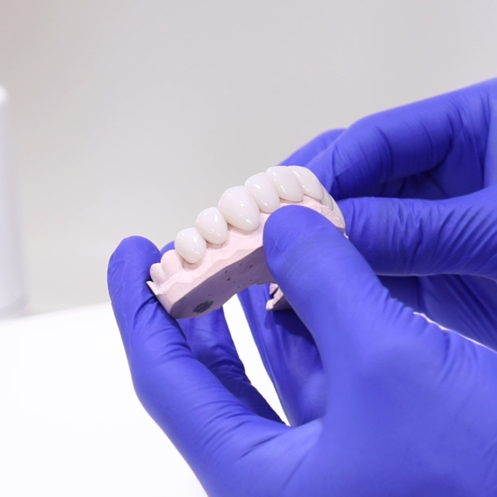 Porcelain veneers model at North Sydney Dentistry