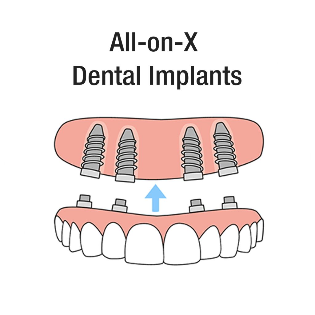 All-on-X dental implants illustration