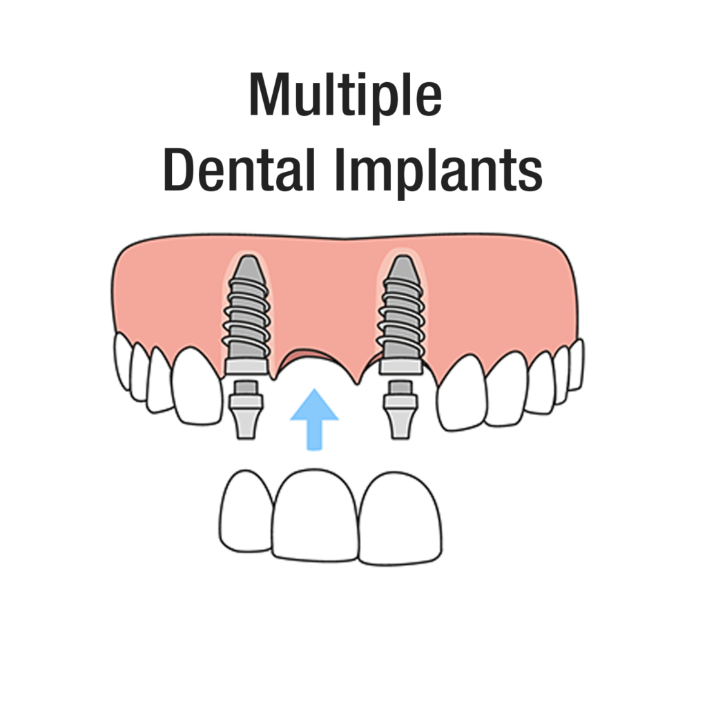Multiple dental implants illustration