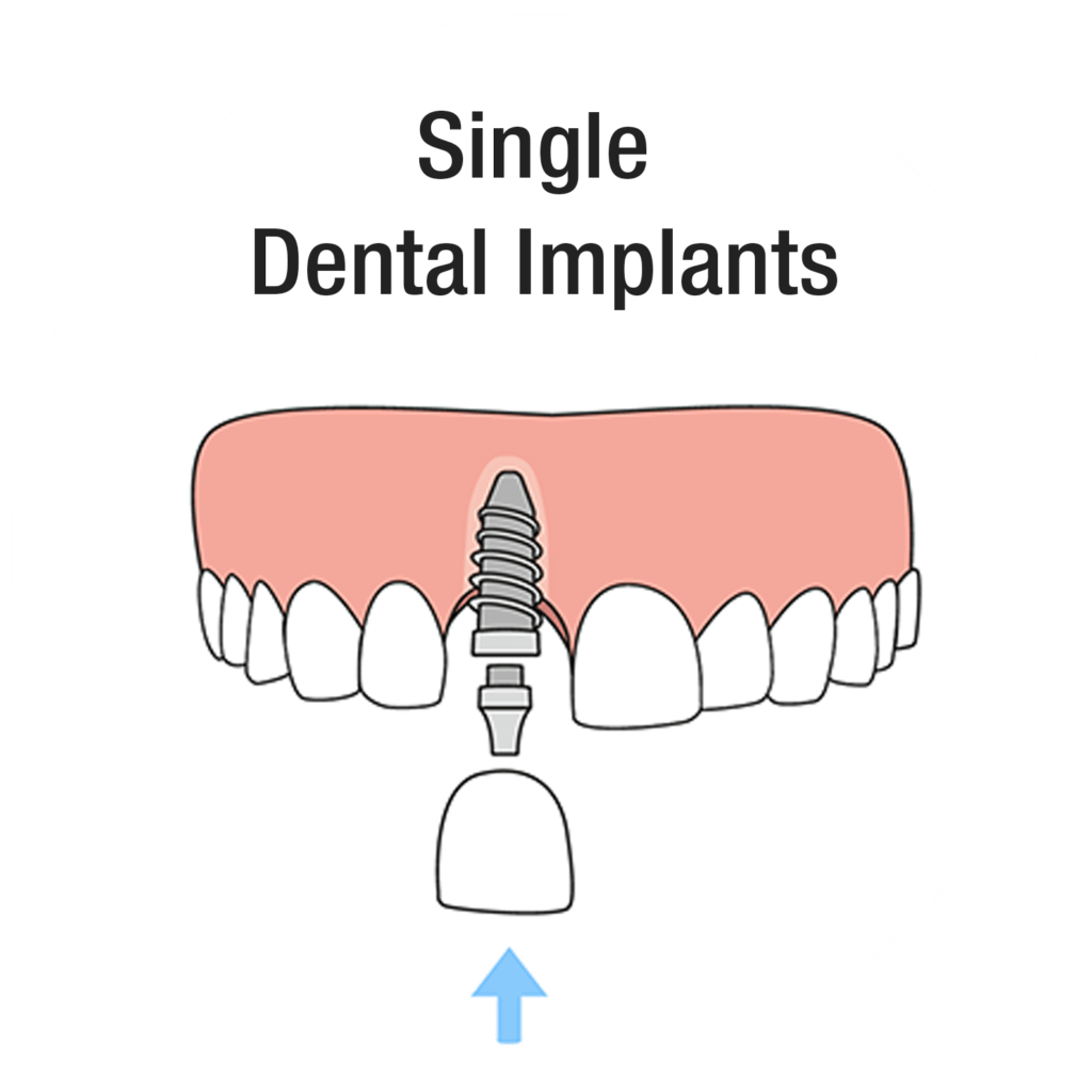 Single dental implant illustration