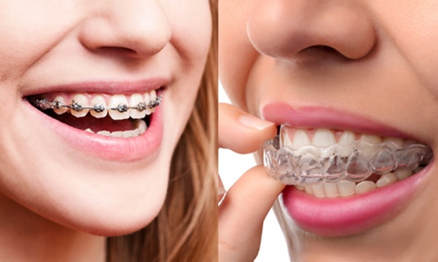 Braces Cost  North Sydney Dentistry