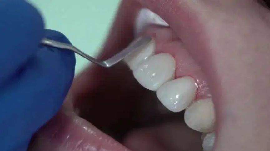 Composite Veneers Cost