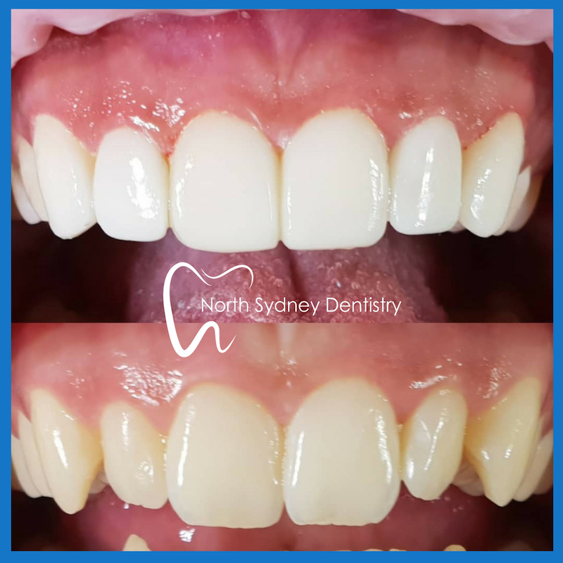 Affordable dental veneers in North Sydney