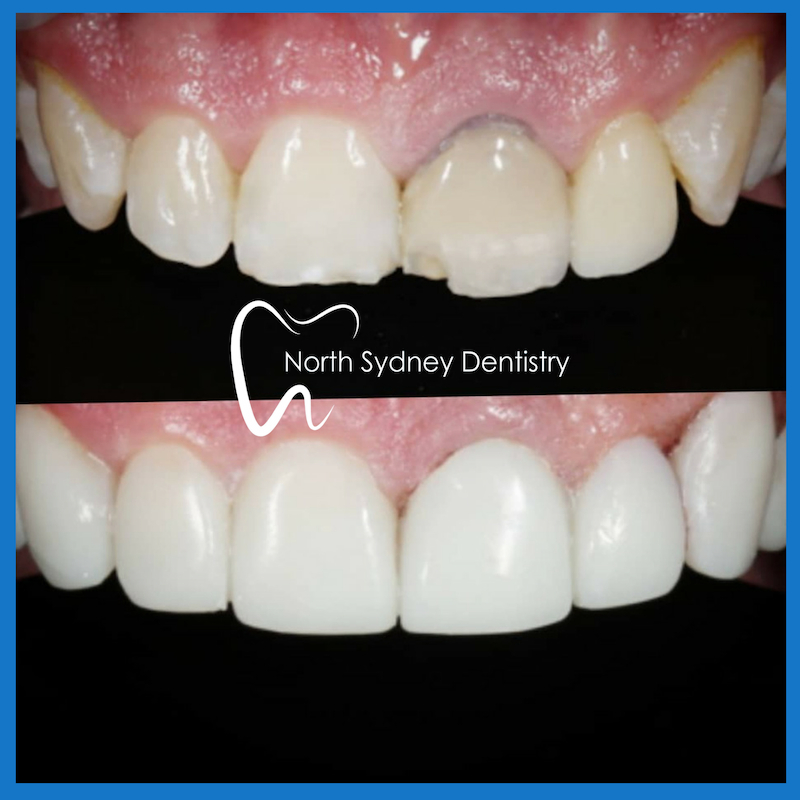 Best dentist for veneers in North Sydney