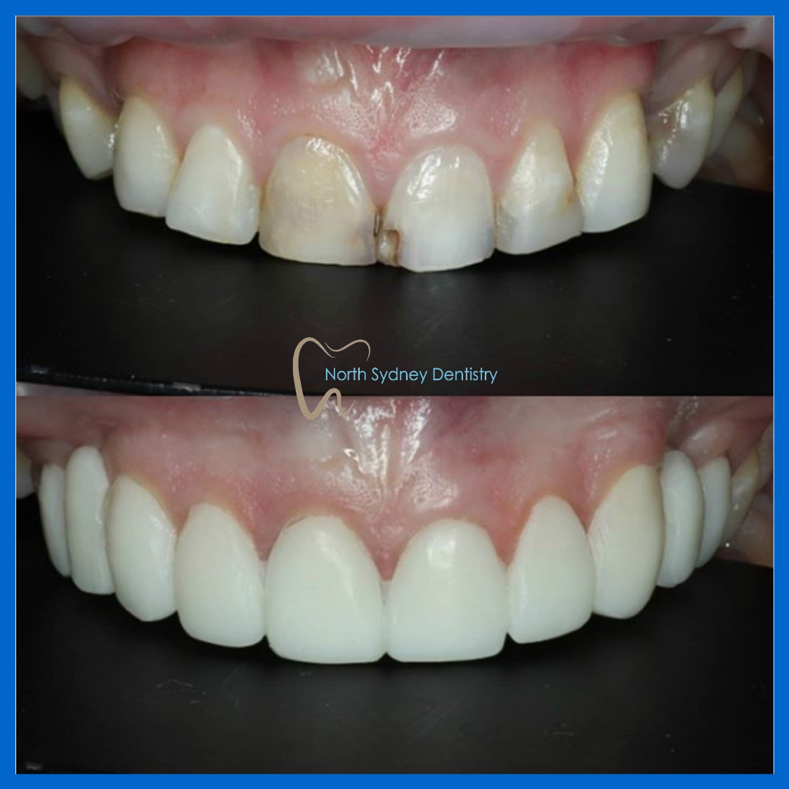 Dental veneers in North Sydney