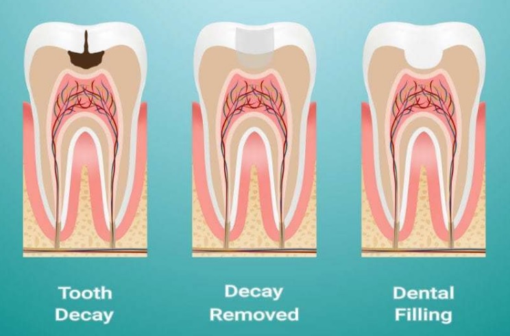 Tooth Filling