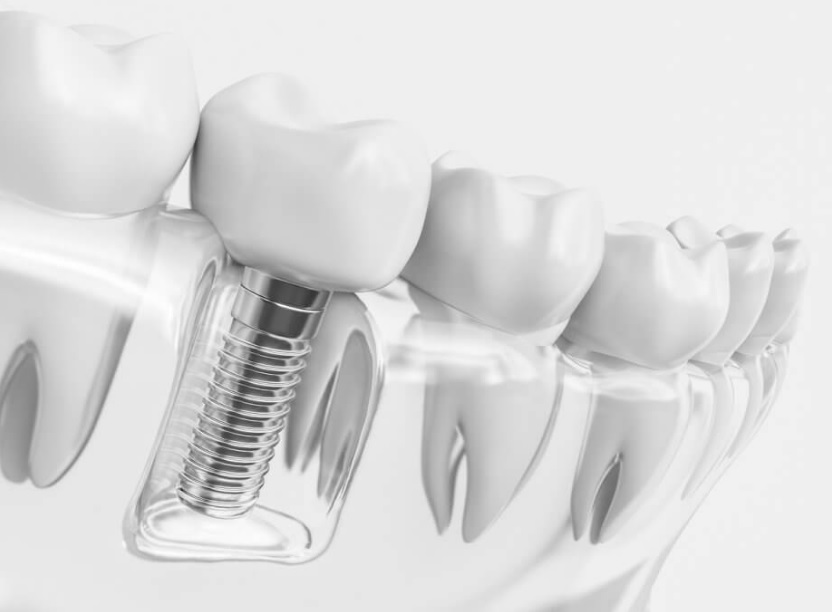 Dental Implants Cost Sydney
