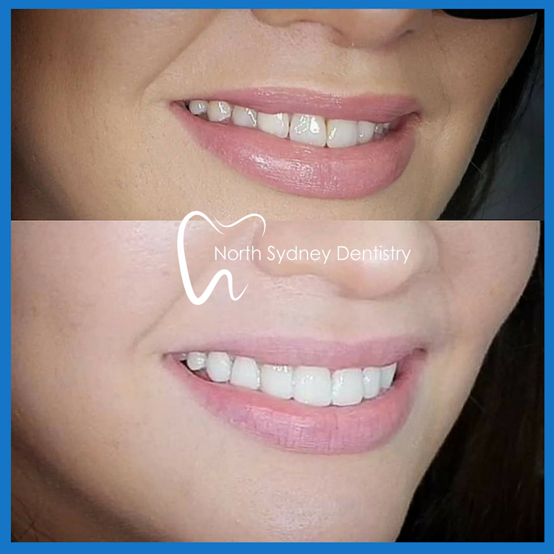 Dental veneers in North Sydney
