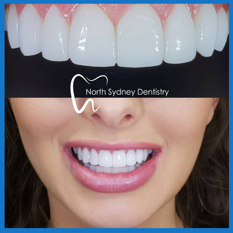 Porcelain veneers in North Sydney