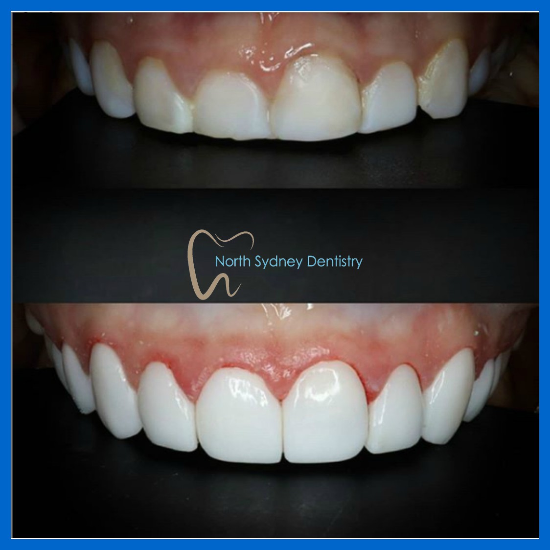 Affordable dental veneers in North Sydney