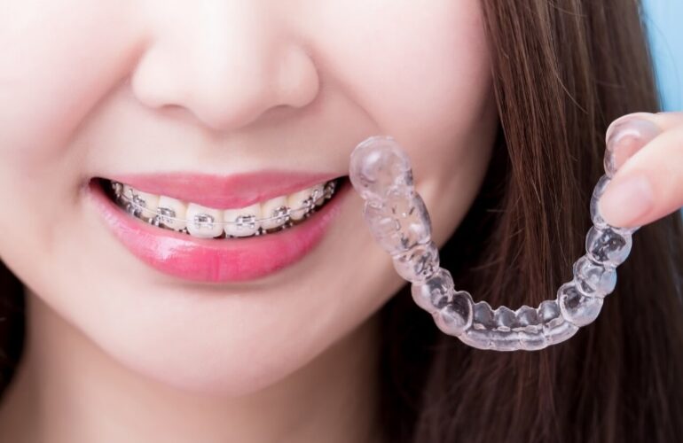 Invisalign vs braces cost