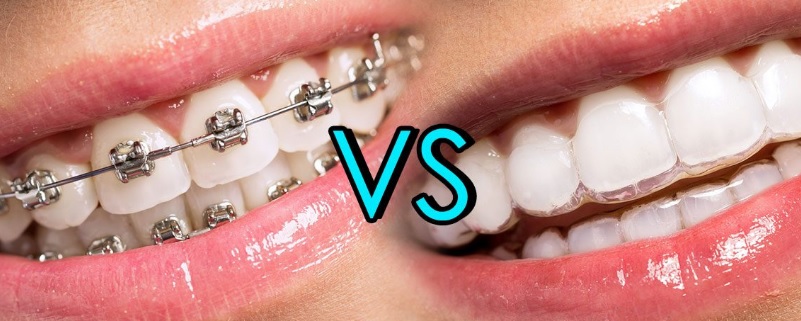 Invisalign vs braces cost