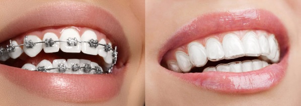 Invisalign vs braces cost in North Sydney