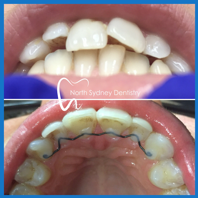 Invisalign in North Sydney