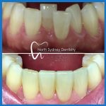 Clear braces in North Sydney