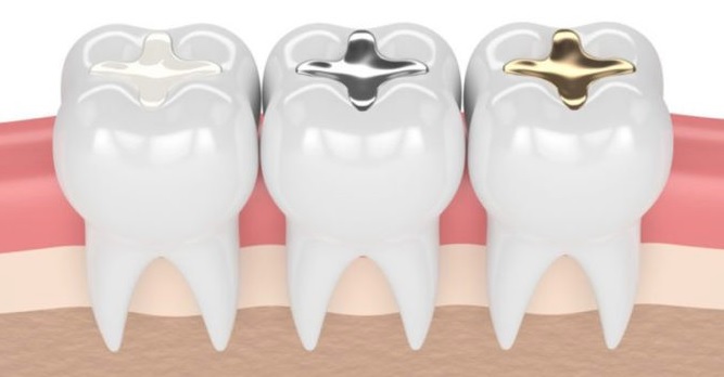 Dental Fillings in North Sydney