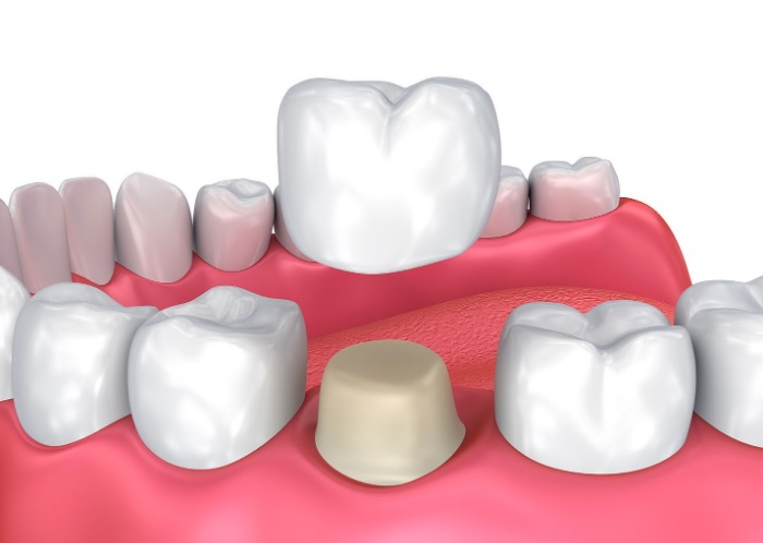 Dental crowns in North Sydney