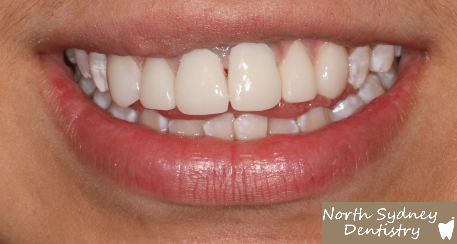 North-Sydney-Dentistry-Veneers-After-1