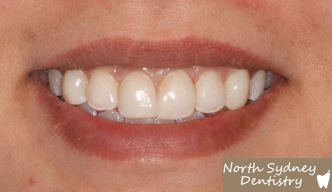 North-Sydney-Dentistry-Veneers-After-2