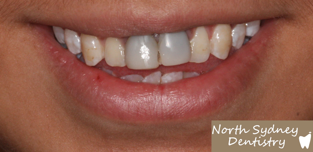 North-Sydney-Dentistry-Veneers-Before-1