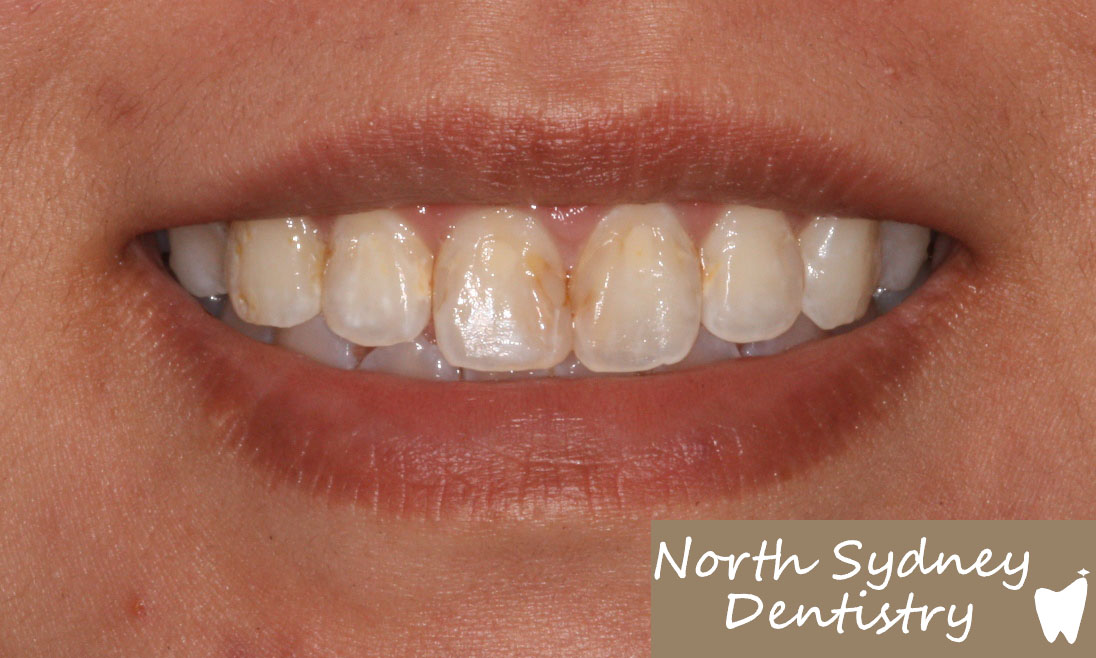 North-Sydney-Dentistry-Veneers-Before-2