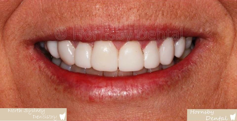 North_Sydney_Dental_Care_Veneer_Case_01-After