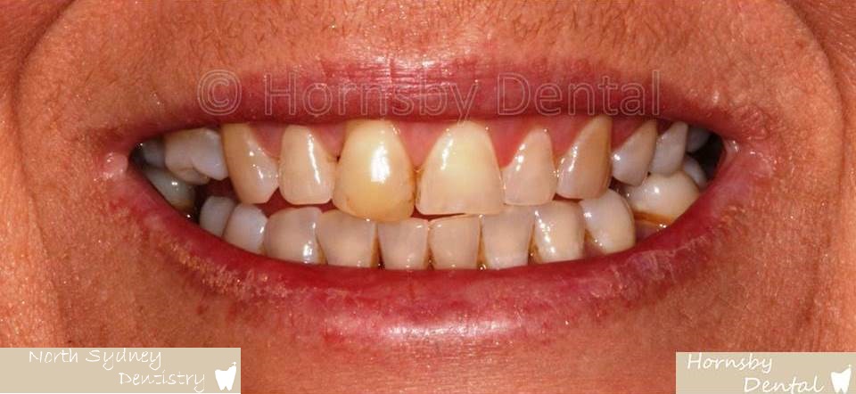 North_Sydney_Dental_Care_Veneer_Case_01-Before