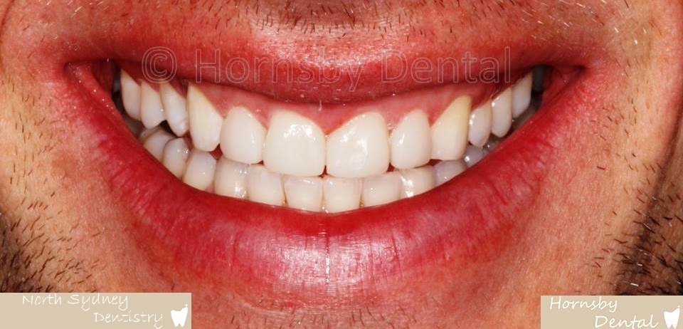 North_Sydney_Dental_Care_Veneer_Case_02-After