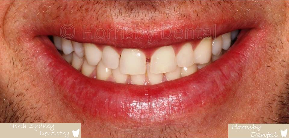 North_Sydney_Dental_Care_Veneer_Case_02-Before