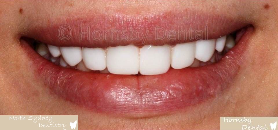 North_Sydney_Dental_Care_Veneer_Case_03-After