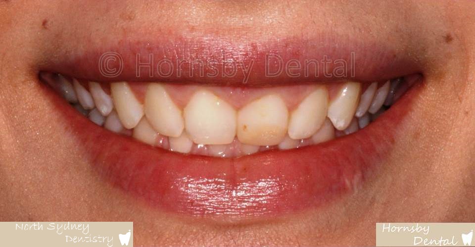 North_Sydney_Dental_Care_Veneer_Case_03-Before