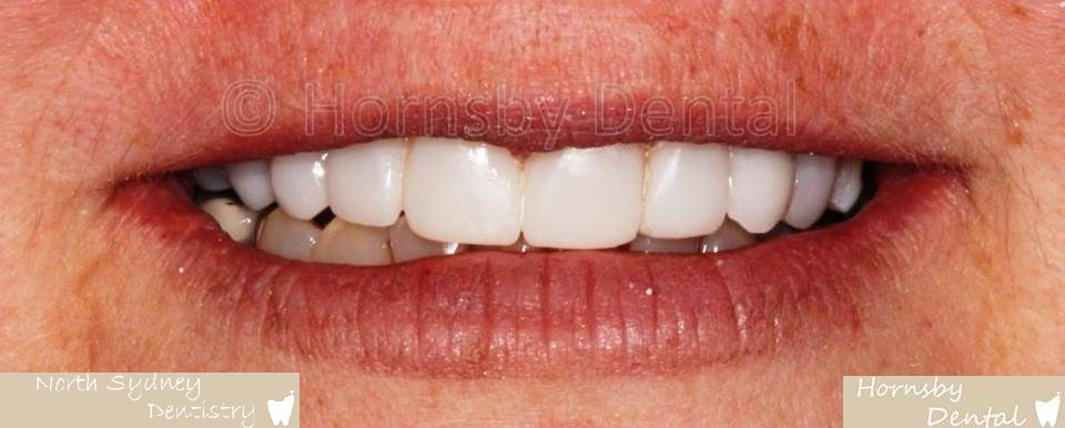 North_Sydney_Dental_Care_Veneer_Case_04-After